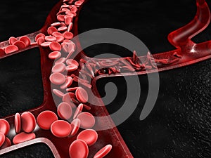 Anemia, sickle cell and normal red blood cell, 3d Illustration