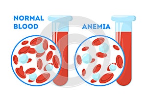 The Anemia symptoms. Normal and anemia blood