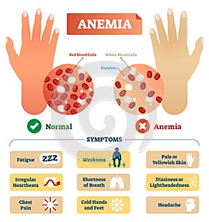 Anemia vector illustration. Labeled scheme with red blood cells.