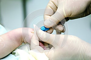 An anesthesiologist establishes a peripheral catheter to monitor the condition of the patient during surgery on the hand before su