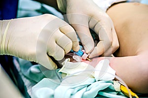 An anesthesiologist installs a peripheral catheter on the patient`s arm to monitor the condition during surgery.