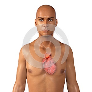 Aneurism of ascending aorta