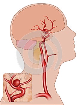 Aneurisma fusiforme cerebral photo