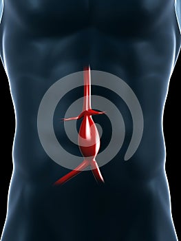 Aneurysm of the aorta photo