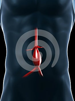 Aneurysm of the aorta