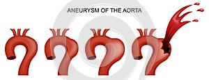 Aneurysm of the aorta. cardiology photo