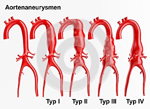 Aneurysm - 3D rendering