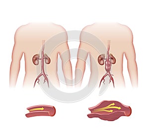 Abdominal aortic aneurysm