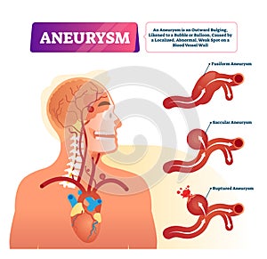 Aneurysm vector illustration. Labeled medical outward bulging vessel scheme