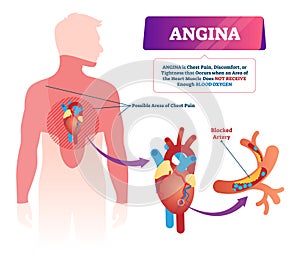 Angina vector illustration. Labeled medical chest pain and heart problem.