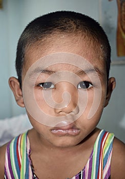 Angioedema at eyelids and lips of Asian male child. Puffy face. Edematous child. Caused by nephritis  nephrotic syndrome  drug 