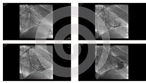 Angiogram of Left Ventricle