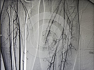 Angiogram of leg vessels, both calf