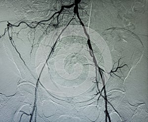Angiogram of pelvic vessels photo