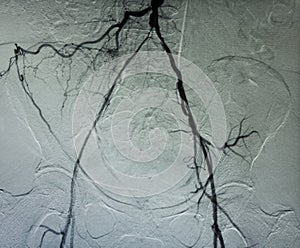 Angiogram of pelvic vessels