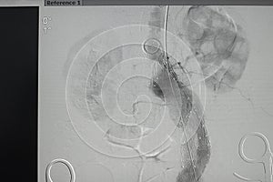 Angiogram renal artery after coil embolization procedure. X-ray images of Angiogram was performed right renal artery photo