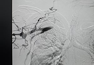 Angiogram of right common iliac artery after aortic stent graft