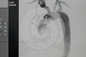 Angiogram of right common iliac artery after aortic stent graft deployed at infra renal abdominal aortic aneurysm during