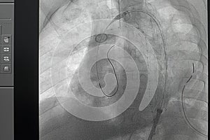 Angiogram of right common iliac artery after aortic stent graft deployed at infra renal abdominal aortic aneurysm during