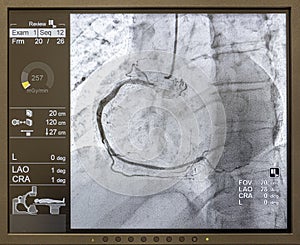 Angiogram sequence working clockwise using x-rays with a contrast agent injected from a tube inserted into the arteries (left &