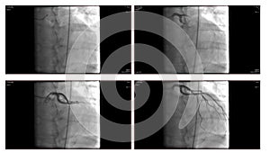 Angiogram photo