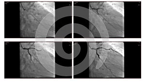 Angiogram photo