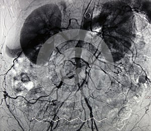 Angiography of Aorta and Branches