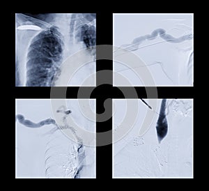 Angiography of brachial artery with Balloon dilatation