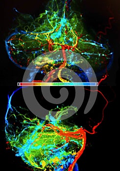 brain arteries an veins, angiography photo