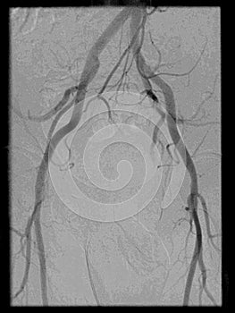 Angiography of the pelvis region