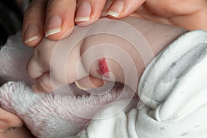 Angioma or pink hemangioma on a baby`s arm photo