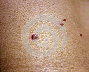 Angioma. Red birthmark on the skin surface