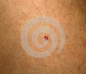 Angioma. Red mole on the body. Birthmark on skin