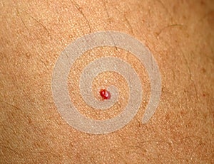 Angioma. Red mole on the body. Birthmark on skin