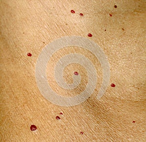 Angioma on the skin. Red moles on the body. Many birthmarks.