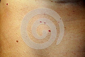 Angioma on the skin. Red moles on the body. Many birthmarks.