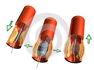 Angioplastie 