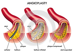 Angioplasty