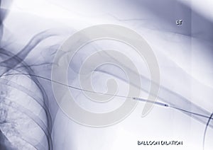 Angioplasty, balloon angioplasty and percutaneous transluminal angioplasty (PTA) on Left arm