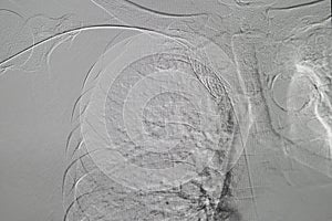 Angioplasty, balloon angioplasty and percutaneous transluminal angioplasty PTA photo