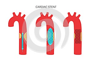 Angioplasty cardiac stent