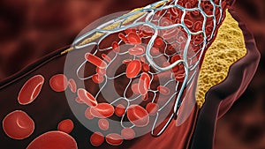 Angioplasty 3D rendering illustration. Deployed Stent within a diseased artery or blood vessel clogged by cholesterol or atheroma photo