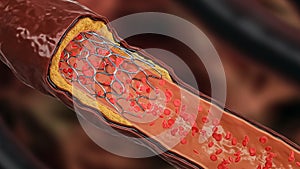 Angioplasty 3D rendering illustration. Deployed Stent within a diseased artery or blood vessel clogged by cholesterol or atheroma photo