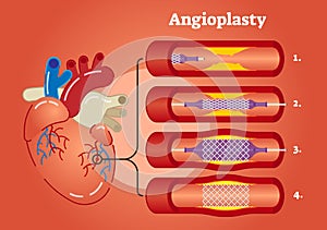 Angioplasty illustration photo