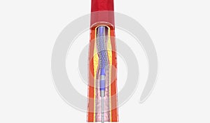Angioplasty is a minimally invasive procedure that uses a cathet