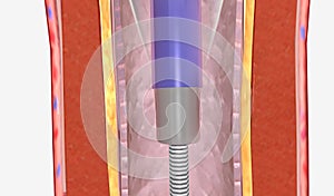 Angioplastika je minimálně invazní postup používá 