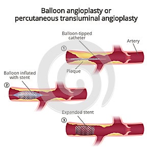 Balloon angioplasty photo