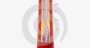 Angioplasty is a procedure designed to restore blood flow within your arteries