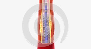 Angioplasty is a procedure designed to restore blood flow within your arteries