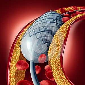 Angioplasty And Stent Concept photo